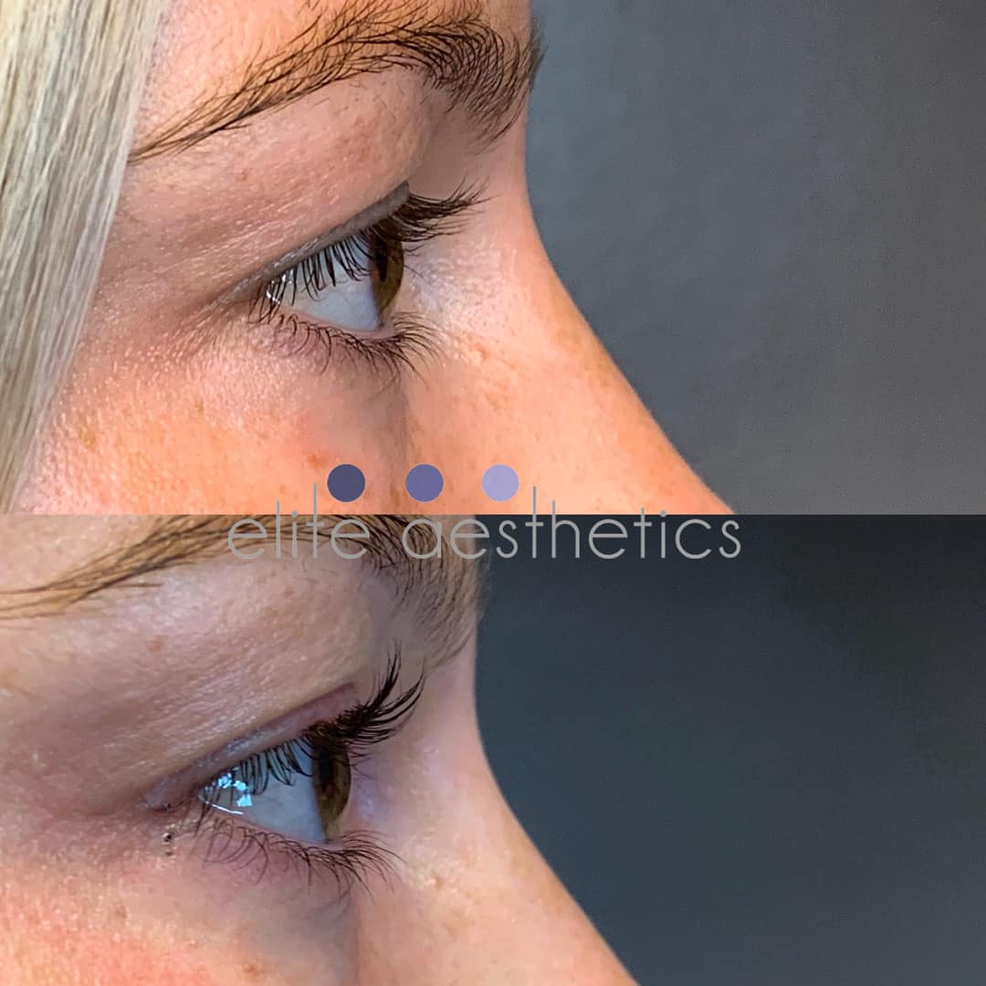 Filler Overland Park Kansas